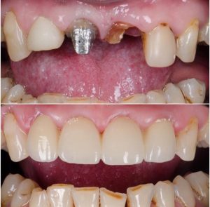 کاربرد روکش دندانی