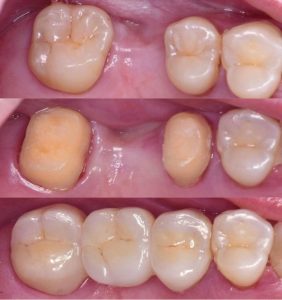 بریج دندانی چیست بریج دندانی در خوی دندانپزشک در خوی