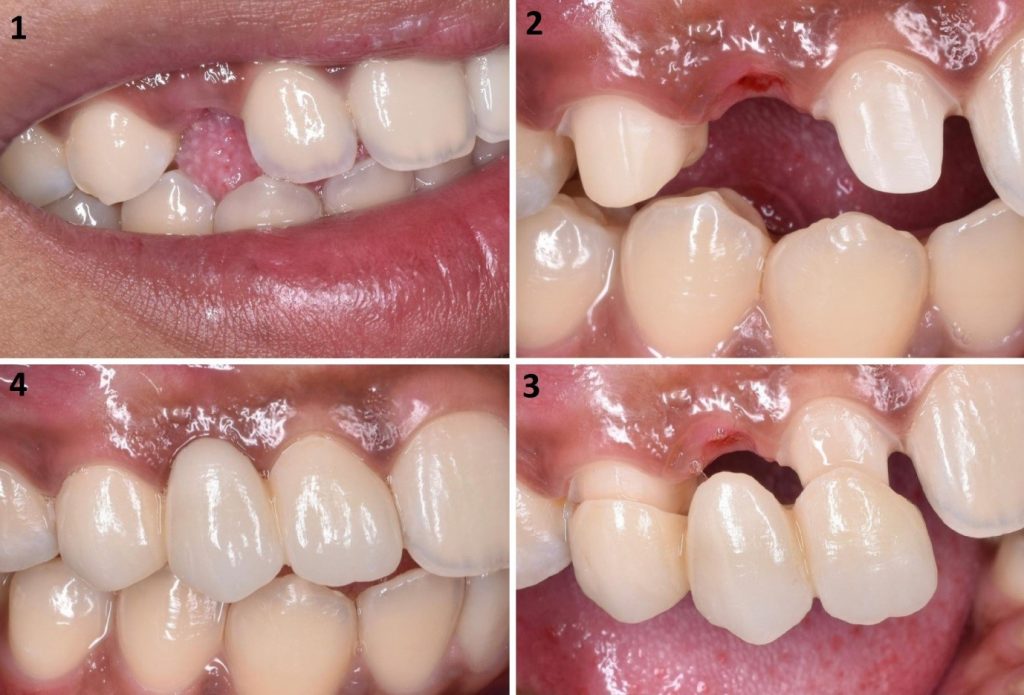 بریج دندانی و ایمپلنت دندانی در خوی دندانپزشک دکتر نگین واعظی در خوی