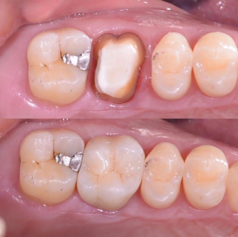 تفاوت روکش دندانی با ایمپلت چیست؟