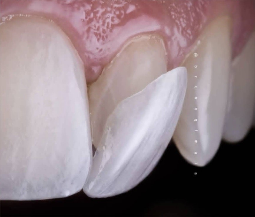 لمینیت سرامیکی در خوی دکتر نگین واعظی