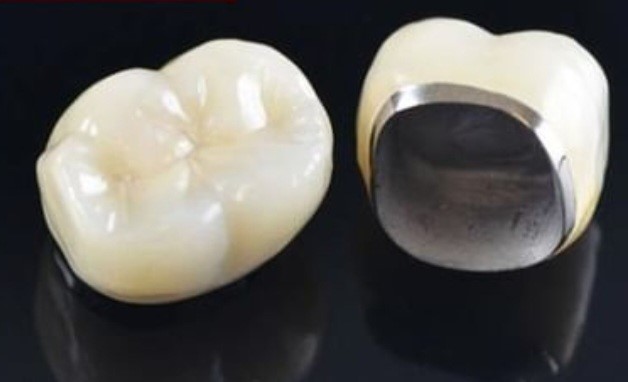 انواع روکش دندانی در خوی