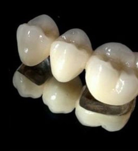 بریج متال سرامیک در خوی