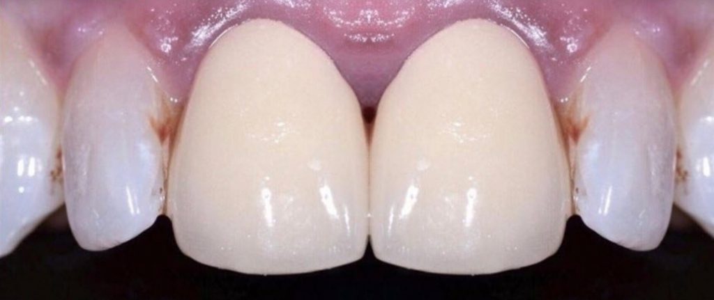 لمینت سرامیکی دندان در خوی دندانپزشکی زیبایی در خوی