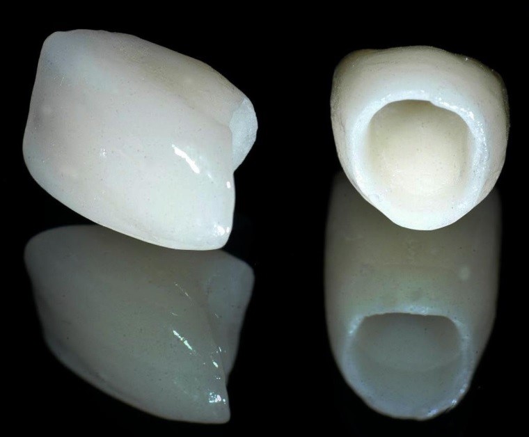 روکش تمام سرامیک دندان در خوی 