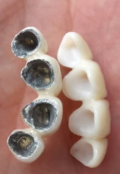 روکش تمام سرامیکی