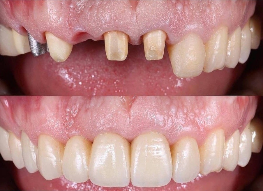 طول عمر و دوام روکش های دندانی چقدر است