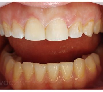 نمونه کار ترمیم دندان توسط خانم دکتر نگین واعظی؛ دندانپزشک ترمیمی در ولیعصر تبریز