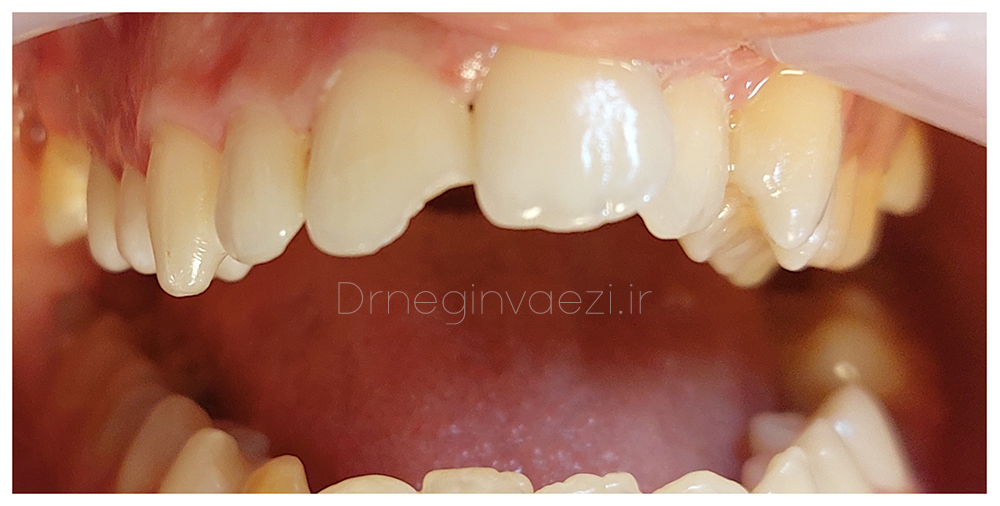 نمونه کار ترمیم شکستگی دندان
