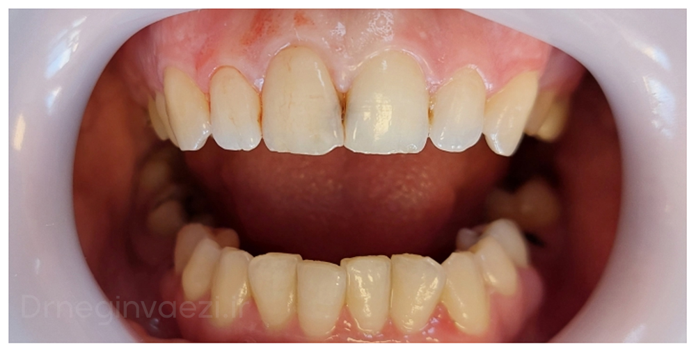 حذف پوسیدگی و ترمیم در دو دندان سنترال بالا