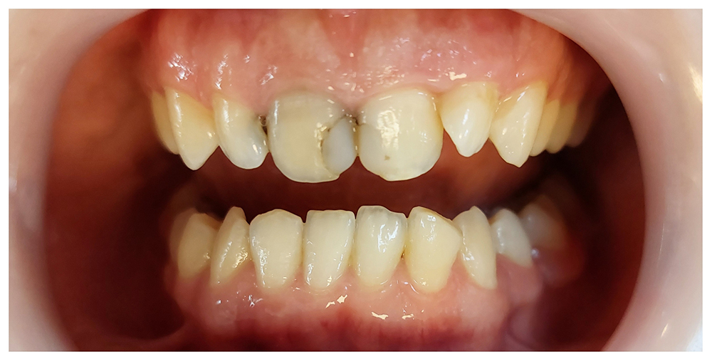 نمونه کار دندانپزشکی ترمیمی دکتر نگین واعظی