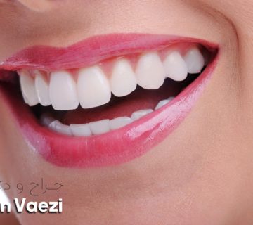 تفاوت لمینت سرامیکی با ونیر کامپوزیت و بلچینگ را از زبان دکتر نگین واعظی دندانپزشک زیبایی در خوی بشنوید