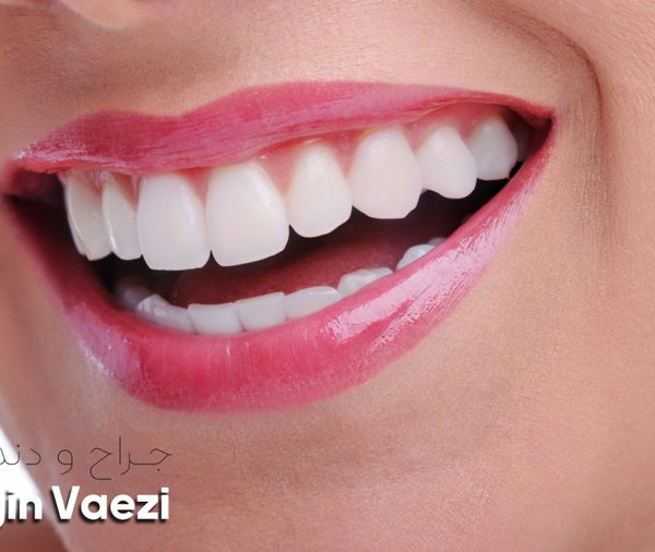 تفاوت لمینت سرامیکی با ونیر کامپوزیت و بلچینگ را از زبان دکتر نگین واعظی دندانپزشک زیبایی در خوی بشنوید