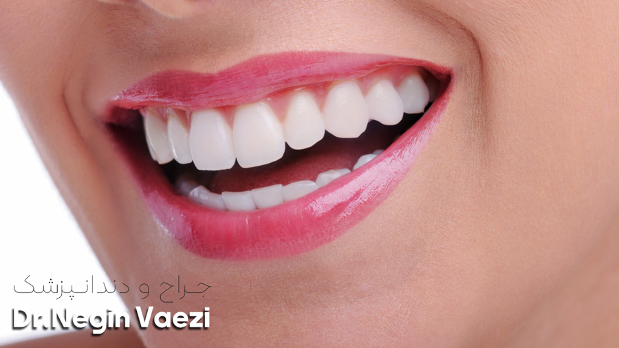 تفاوت لمینت سرامیکی با ونیر کامپوزیت و بلچینگ را از زبان دکتر نگین واعظی دندانپزشک زیبایی در خوی بشنوید