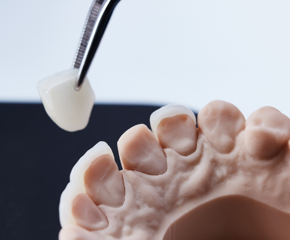 درمان لمینت سرامیکی چند جلسه زمان می برد - انجام لمینت در خوی و تبریز