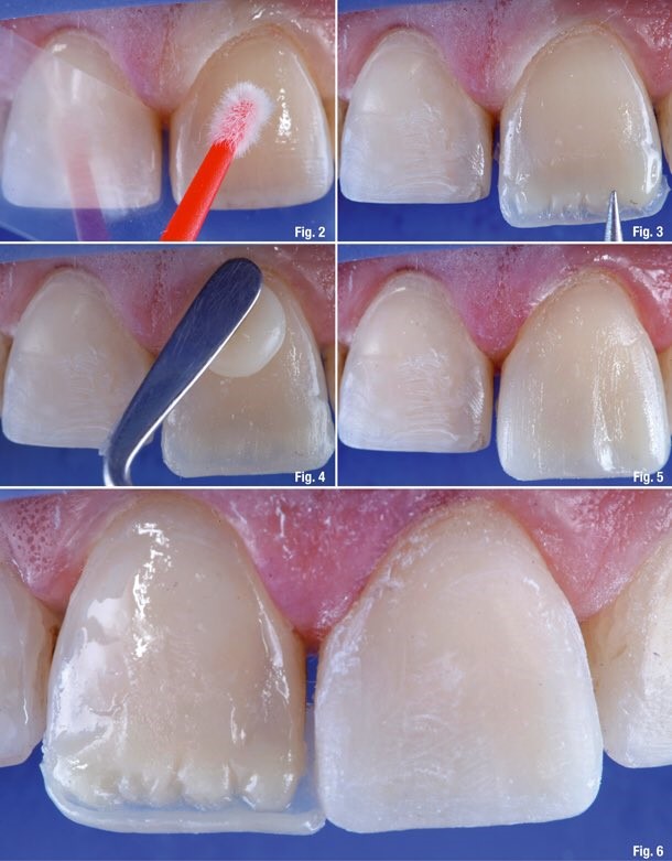 ونیر کامپوزیت ارزان در خوی چگونه انجام می شود