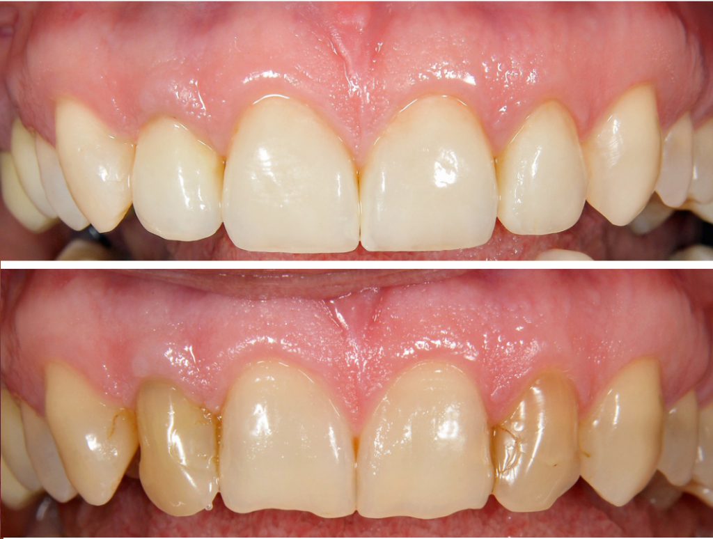 انجام ونیر کاپوزیتی در خوی و تبریز توسط دکتر نگین واعظی جراح و دندانپزشک خانم در خوی و تبریز