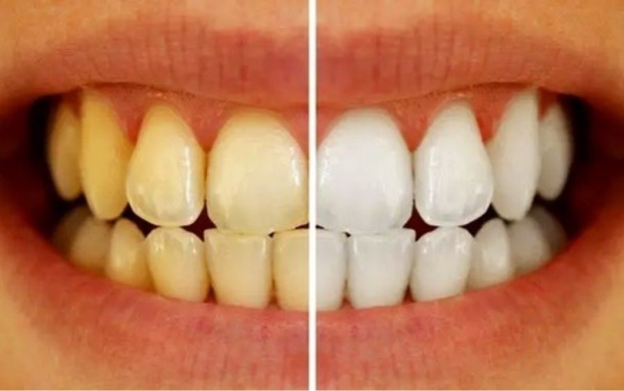 3. بلیچینگ Bleaching یا همان سفید کردن دندان ها در خوی توسط جداح و دندانپزشک زن دکتر نگین واعظی