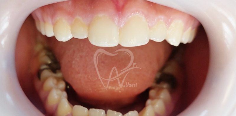 دندانپزشکی طرح لبخند در خوی و تبریز توسط دکتر نگین واعظی جراح و دندانپزشک زن در خوی و تبریز