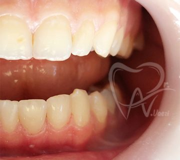 نمونه درمان ترمیم دندان جلو با کامپوزیت در تبریز؛ بازسازی پوسیدگی و شکستگی