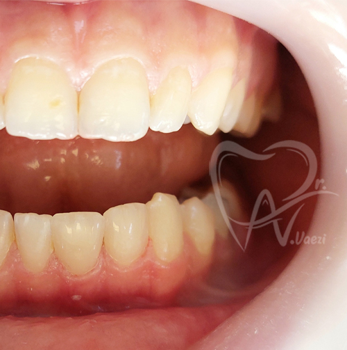 دندانپزشکی زیبایی و طرح لبخند در خوی دکتر نگین واعظی