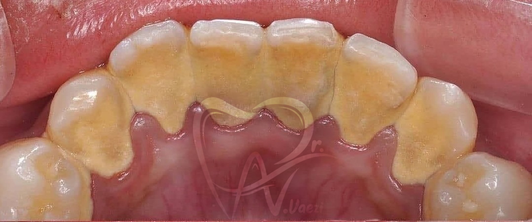 جرم گیری دندان در خوی برساژ دندان در خوی تبریز جرم گیری دندان توسط دندانپزشک زن در خوی