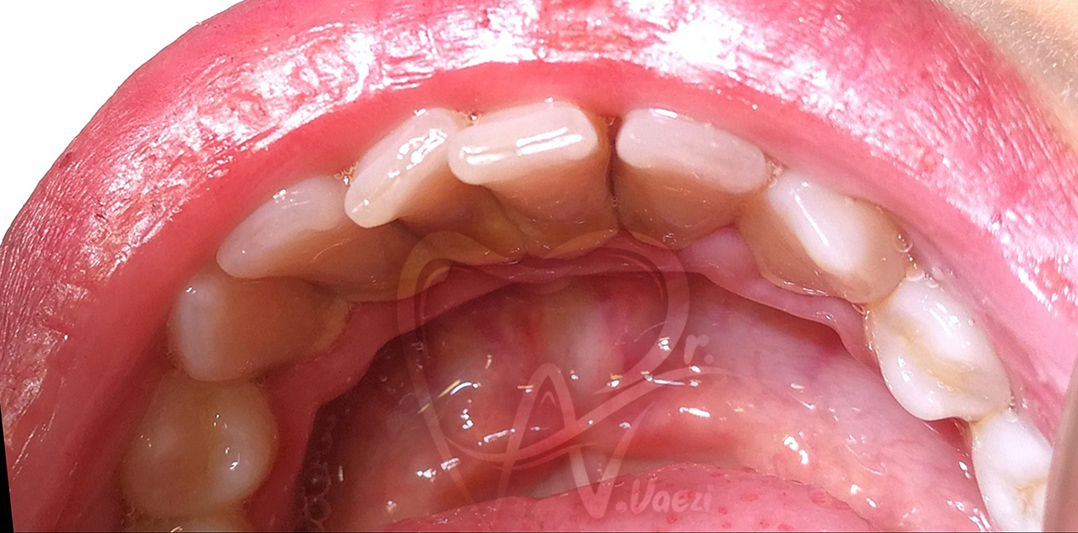 جرم گیری فک پایین دکتر نگین واعظی خوی تبریز
