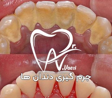 تصاویر قبل و بعد جرم‌گیری و برساژ دندان در تبریز توسط دکتر نگین واعظی دندانپزشک خانم در ولیعصر تبریز