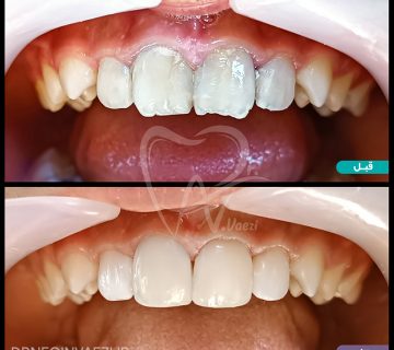 نمونه ترمیم کامپوزیت 4 دندان جلو بیمار نوجوان در تبریز