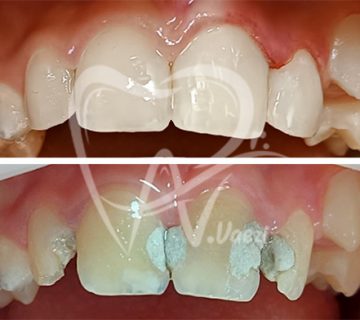 درمان ریشه و ترمیم کامپوزیتی تاجی برای دندان های جلو در تبریز