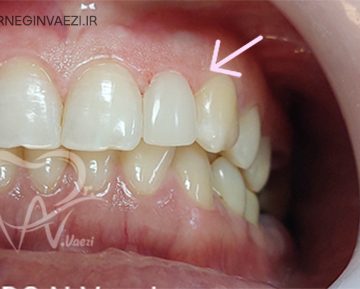 درمان ترمیم کامپوزیتی دندان بدفرم و چرخیده توسط دکتر نگین واعظی جراح و دندانپزشک زیبایی در خوب و تبریز