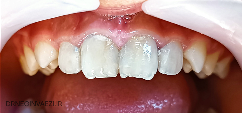 قبل از ترمیم کامپویزیت 4 دندان پیشین