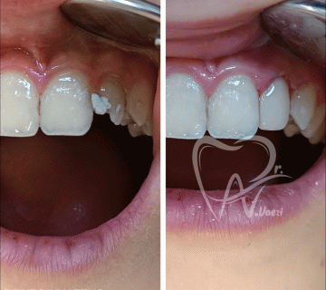 نمونه درمان عصب کشی و ترمیم دندان لترال بیمار نوجوان در تبریز