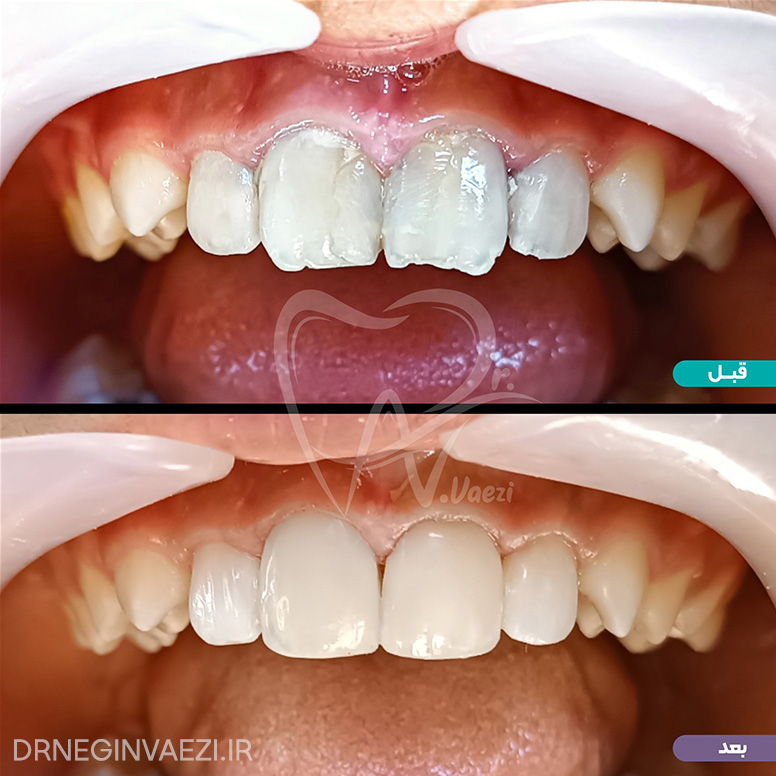 ترمیم کامپوزیت دندان جلو در تبریز برای نوجوان توسط دکتر نگین واعظی دندانپزشک ترمیمی و زیبایی