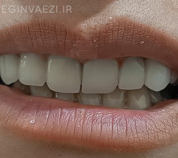 قبل و بعد اصلاح لبخند با روکش های سرامیکی زیرکونیا در تبریز