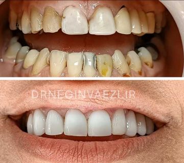 اصلاح لبخند با درمان ترکیبی ونیر کامپوزیتی و روکش زیرکونیا در تبریز
