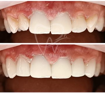 ترمیم ونیز کتمپوزیتی و روکش زیرکونیا و تمام سرامیکی در کلینیک دندانپزشکی دکتر نگین واعظی در تبریز و خوی