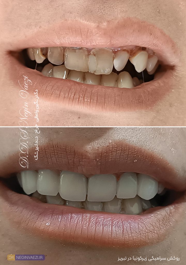 نمونه کار اصلاح لبخند با روکش تمام سرامیکی زیرکونیا در تبریز توسط دکتر نگین واعظی دندانپزشک زیبایی