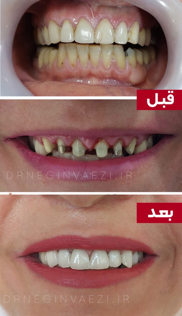اصلاح و بهبود لبخند با روکش های تمام سرامیک زیرکونیوم توسط دکتر نگین واعظی جراح و دندانپزشک زیبایی در تبریز دندانپزشک زیبایی خانم با تخصص بالا و کیفیت کار عالی