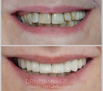 نمونه کار اصلاح طرح لبخند با 8 واحد روکش تمام سرامیکی زیرکونیا در تبریز توسط دکتر نگین واعظی در ولیعصر