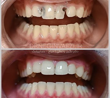 درمان ریشه و ترمیم کامپوزیتی دندان های دائمی پیشین در بیمار نوجوان توسط دکتر نگین واعظی دندانپزشک در تبریز و خوی