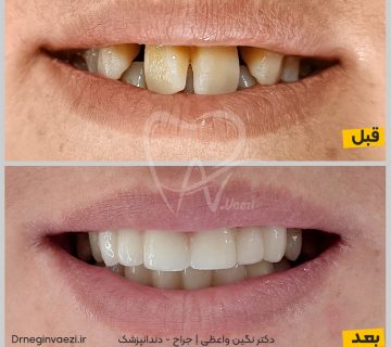 روکش سرامیکی عمر روکش دندان زیرکونیا نمونه کار روکش زیرکونیا فرق روکش زیرکونیا با سرامیک روکش زیرکونیا تمام سرامیک قیمت زیباسازی لبخند