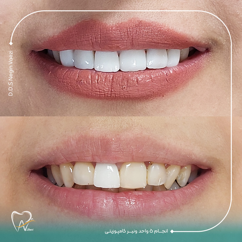 نمونه کار ونیر کامپوزیت در تبریز مطب دکتر نگین واعظی دندانپزشک زیبایی در ولیعصر