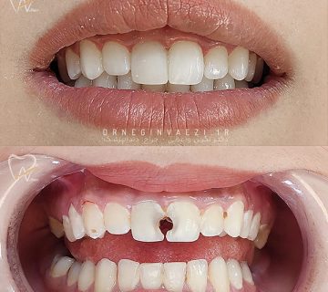 نمونه کار ترمیم کامپوزیت دندان جلو در تبریز توسط دکتر نگین واعظی در تبریز