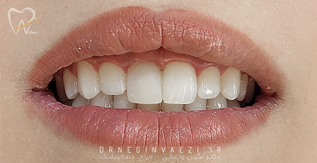 بعد از انجام درمان ریشه و ترمیم کامپوزیت دو دندان پیشین توسط دکتر نگین واعظی جراح و دندان پزشک در تبریز و خوی