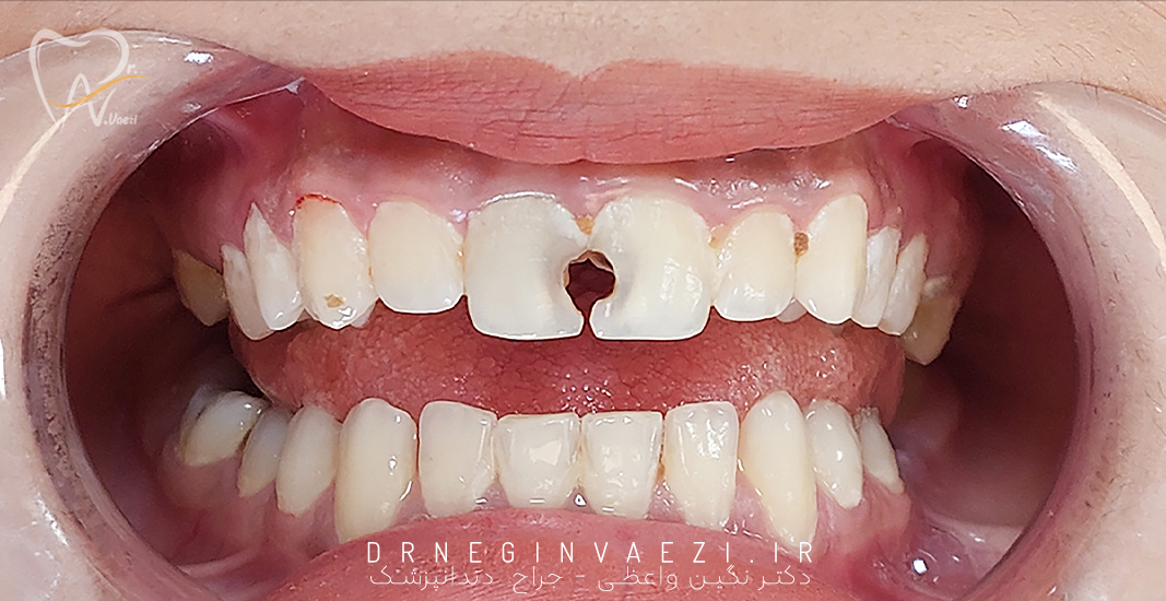 ترمیم کامپوزیت در تبریز دکتر نگین واعظی ترمیم کامپوزیت درمان ریشه