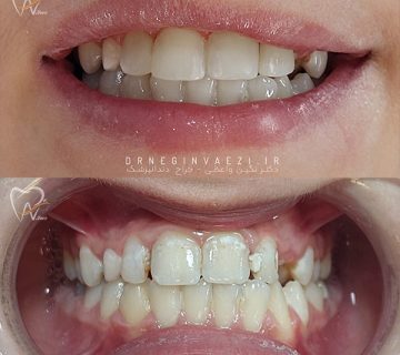 انجام ترمیم تاجی کامپوزیتی هزینه ترمیم کامپوزیت بهترین دکتر ترمیم کامپوزیت تبریز دکتر نگین واعظی هزینه ترمیم کامپوزیت دندان جلو