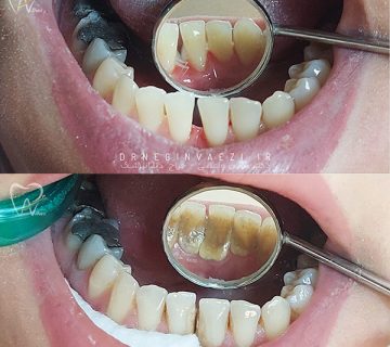 جرم گیری دندان بلیپچینگ دندان در تبریز در خوی توسط دکتر نگین واعظی نمونه جرک گیری دندان ها