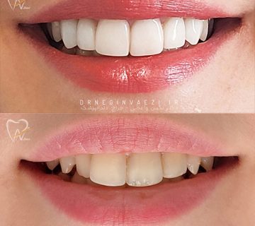 ونیر کامپوزیت در تبریز انجام ونیر در تبریز دکتر زیبایی در تبریز دندانپزشک زیبایی خوب برای ونیر کامپوزیتی در تبریز قیمت ونیر کامپوزیت دندنا های جلو دکتر نگین واعظی