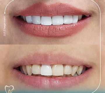 قیمت کامپوزیت دندان در تبریز کامپوزیت دندان در تبریز نی نی سایت کامپوزیت دندان در تبریز اقساطی ورق کامپوزیت تبریز کامپوزیت ارزان تبریز بهترین دکتر کامپوزیت دندان در تبریز خدمات دندانپزشکی اقساطی در تبریز دندانپزشک زیبایی تبریز